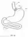 Fig. 04 - Attachment system for transmural attachment at the gastroesophageal junction