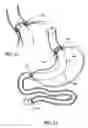 Fig. 06 - Attachment system for transmural attachment at the gastroesophageal junction