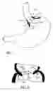 Fig. 09 - Attachment system for transmural attachment at the gastroesophageal junction