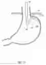 Fig. 28 - Attachment system for transmural attachment at the gastroesophageal junction