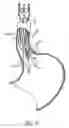 Fig. 29 - Attachment system for transmural attachment at the gastroesophageal junction