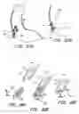 Fig. 44 - Attachment system for transmural attachment at the gastroesophageal junction