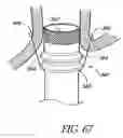 Fig. 49 - Attachment system for transmural attachment at the gastroesophageal junction