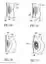 Fig. 50 - Attachment system for transmural attachment at the gastroesophageal junction