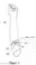 Fig. 04 - Gauze on stick (GOS)