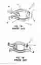 Fig. 02 - Nose clip