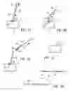 Fig. 03 - Temporary seal and method for facilitating anastomosis