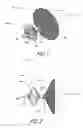 Fig. 02 - Method of implanting an adjustable occlusion device