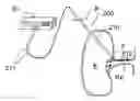 Fig. 01 - Methods and apparatus for treating acute myocardial infarction
