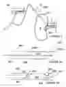 Fig. 04 - Methods and apparatus for treating acute myocardial infarction