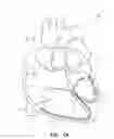 Fig. 02 - Neural stimulation system for cardiac fat pads