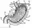 Fig. 01 - Process and electrostimulation device for treating obesity and/or gastroesophageal reflux disease