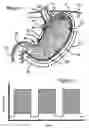 Fig. 02 - Process and electrostimulation device for treating obesity and/or gastroesophageal reflux disease
