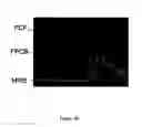 Fig. 03 - Miniaturized high-density multichannel electrode array for long-term neuronal recordings