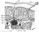 Fig. 01 - Percutaneous endoscopic access tools for the spinal epidural space and related methods of treatment