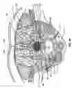 Fig. 03 - Percutaneous endoscopic access tools for the spinal epidural space and related methods of treatment