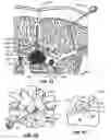 Fig. 13 - Percutaneous endoscopic access tools for the spinal epidural space and related methods of treatment