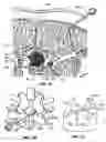Fig. 15 - Percutaneous endoscopic access tools for the spinal epidural space and related methods of treatment