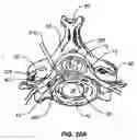 Fig. 35 - Percutaneous endoscopic access tools for the spinal epidural space and related methods of treatment
