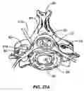 Fig. 44 - Percutaneous endoscopic access tools for the spinal epidural space and related methods of treatment