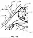 Fig. 45 - Percutaneous endoscopic access tools for the spinal epidural space and related methods of treatment