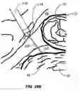 Fig. 47 - Percutaneous endoscopic access tools for the spinal epidural space and related methods of treatment