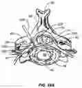 Fig. 48 - Percutaneous endoscopic access tools for the spinal epidural space and related methods of treatment