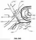 Fig. 49 - Percutaneous endoscopic access tools for the spinal epidural space and related methods of treatment