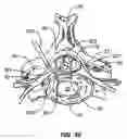 Fig. 50 - Percutaneous endoscopic access tools for the spinal epidural space and related methods of treatment