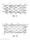 Fig. 09 - Stent with cover connectors