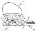 Fig. 01 - Device for closure of a vascular defect and method for treating the same