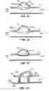 Fig. 07 - ANEURYSM TREATMENT DEVICES