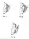 Fig. 04 - Intraocular telescope