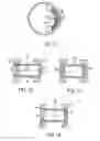 Fig. 05 - Intraocular telescope