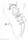Fig. 02 - Bipolar hip prosthesis with free floating ring