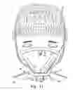 Fig. 07 - Face mask strap system