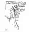 Fig. 02 - Intubation device and method of use