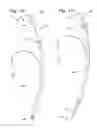 Fig. 11 - Intubation device and method of use
