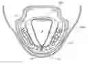 Fig. 01 - Tissue anchoring system for percutaneous glossoplasty