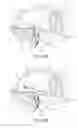 Fig. 04 - Tissue anchoring system for percutaneous glossoplasty