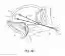Fig. 05 - Tissue anchoring system for percutaneous glossoplasty