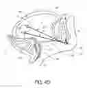 Fig. 06 - Tissue anchoring system for percutaneous glossoplasty