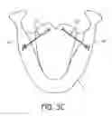 Fig. 08 - Tissue anchoring system for percutaneous glossoplasty