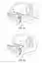 Fig. 09 - Tissue anchoring system for percutaneous glossoplasty