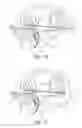 Fig. 12 - Tissue anchoring system for percutaneous glossoplasty