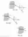 Fig. 27 - Tissue anchoring system for percutaneous glossoplasty