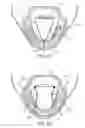 Fig. 32 - Tissue anchoring system for percutaneous glossoplasty