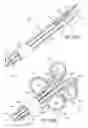 Fig. 56 - Tissue anchoring system for percutaneous glossoplasty