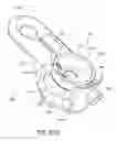 Fig. 59 - Tissue anchoring system for percutaneous glossoplasty