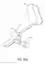 Fig. 70 - Tissue anchoring system for percutaneous glossoplasty